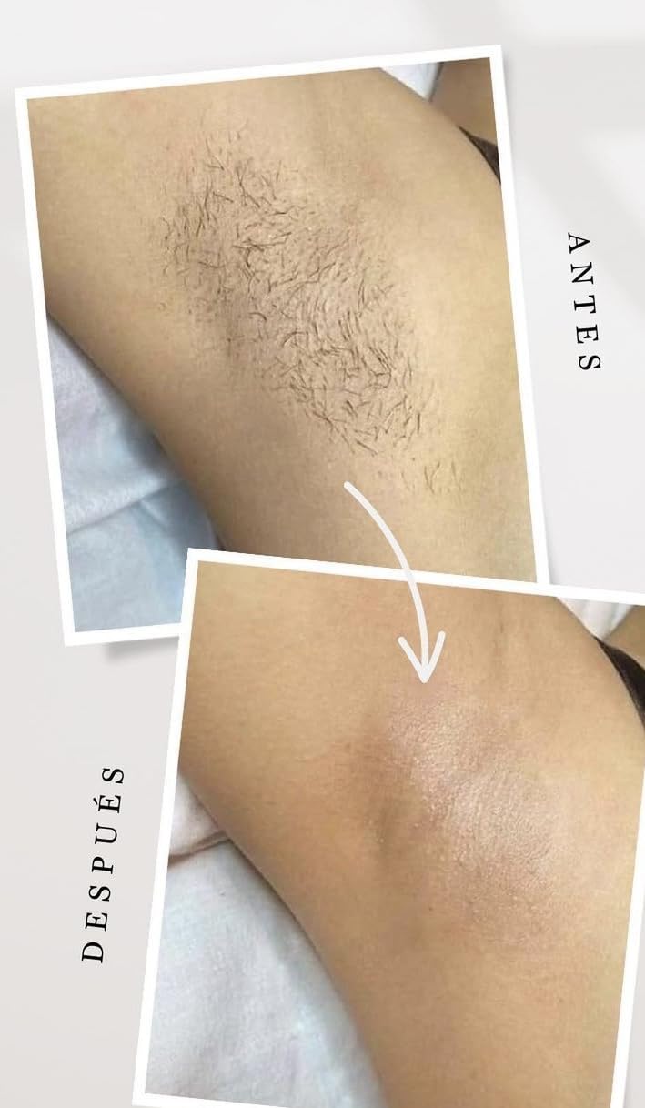 INIA HAUTE Pro Laser Hair Removal with Ice-Cooling Care for Women and Men customer photo 1