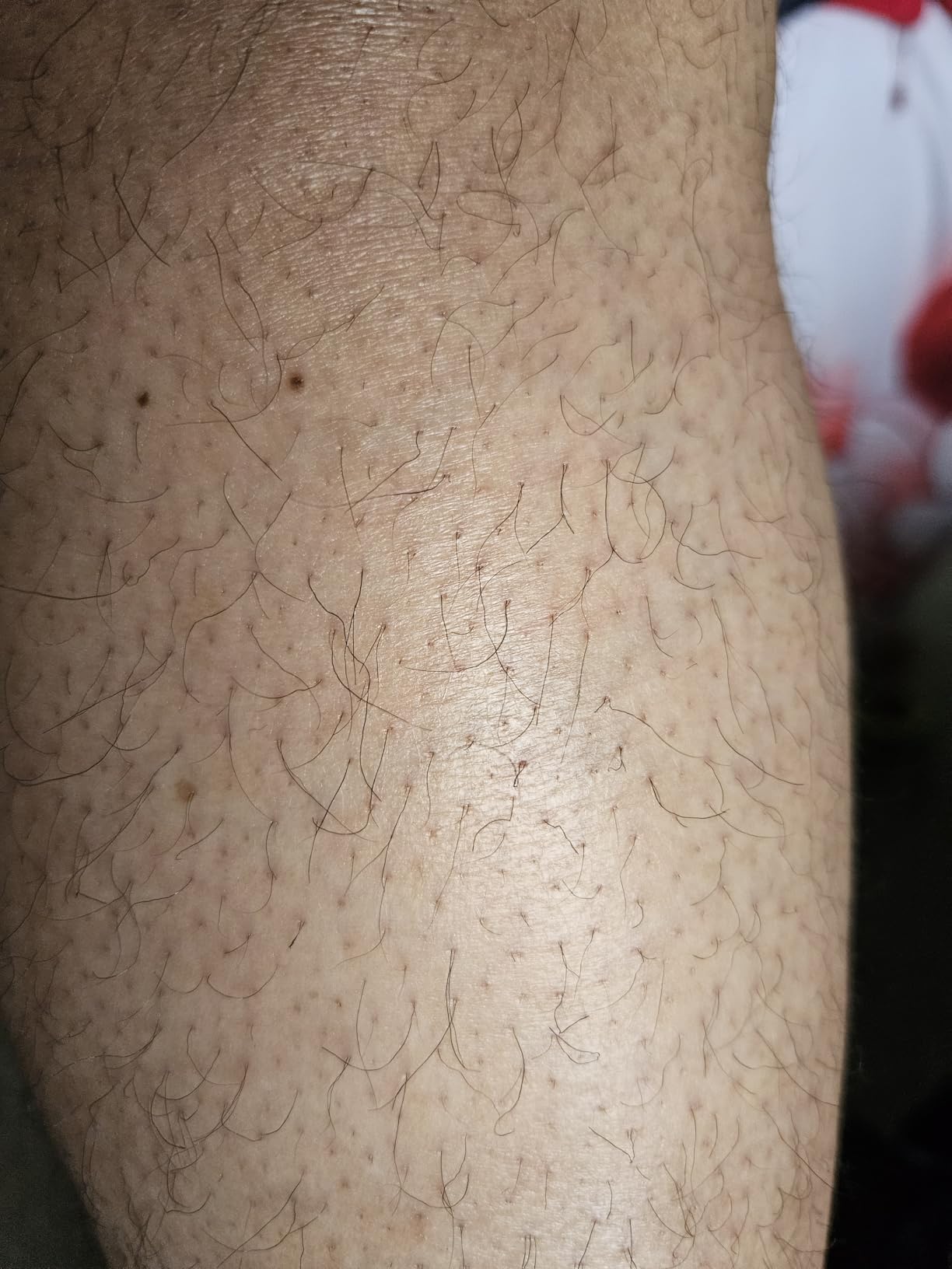 Ulike Laser Hair Removal Device Air 10 Ipl Gift for Women and Men, Ice Cool and Permanent Hair Reduction for Nearly Painless, Dual Lights, Skin Sensor & USHR Mode Hair Removal in 10mins from Home customer photo 2