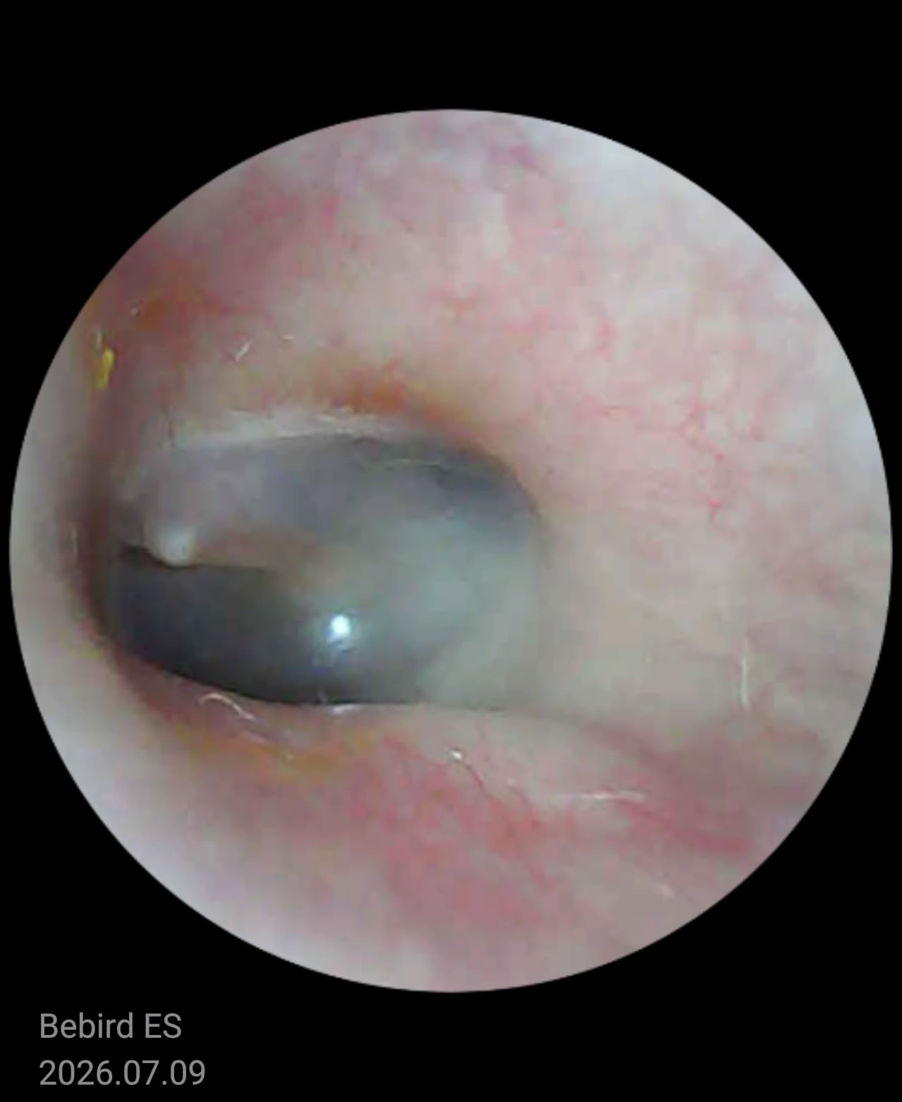 Bebird D39R Ear Wax Removal:Ear Camera with Storage Case &Painless Tweezers customer photo 1